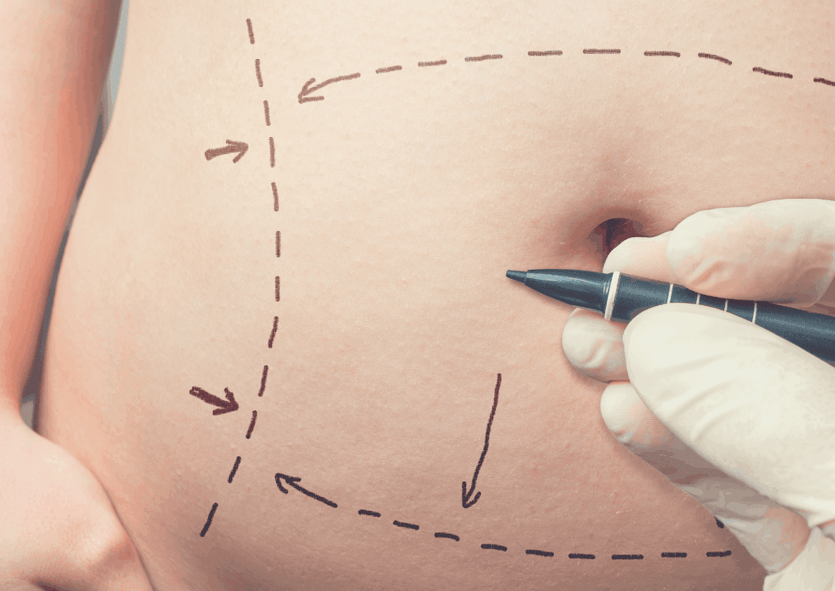 How To Sleep After Tummy Tuck [Complete Guide]