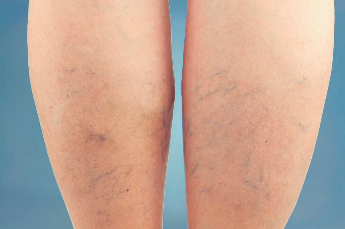 compression socks varicose veins